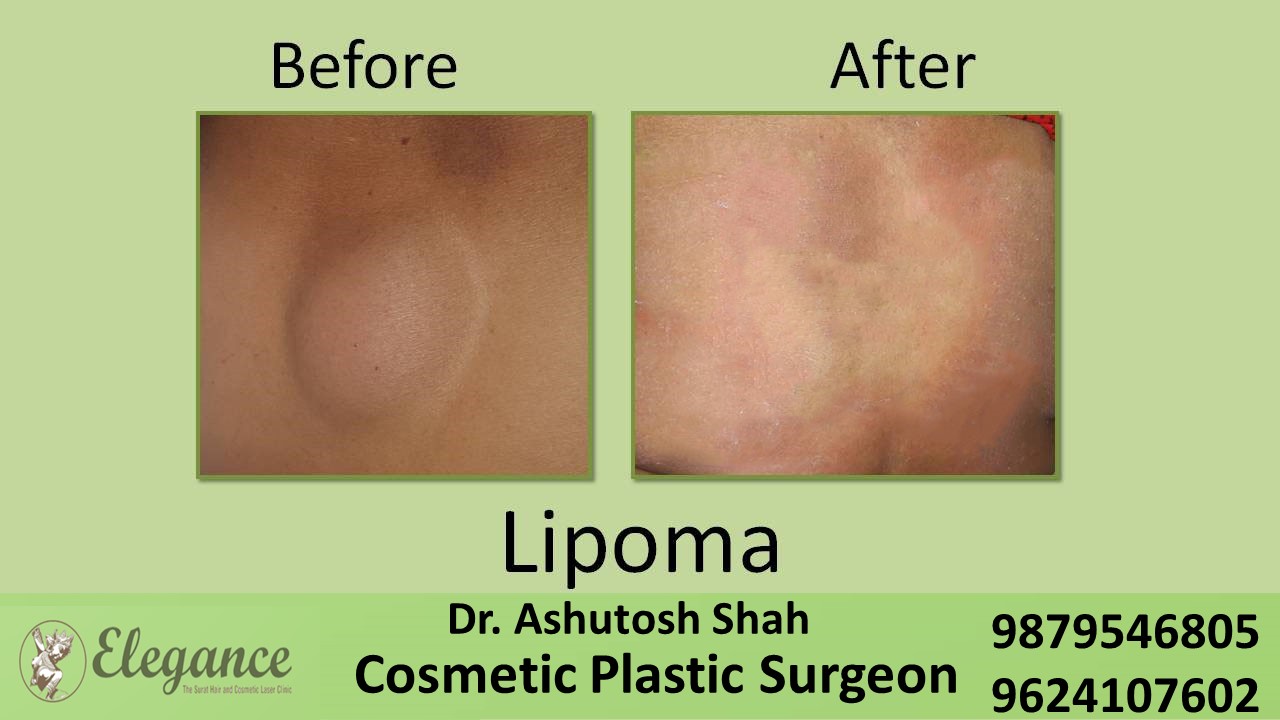 Liposuction Lipoma Removal Surgery Surat, Gujarat, India.