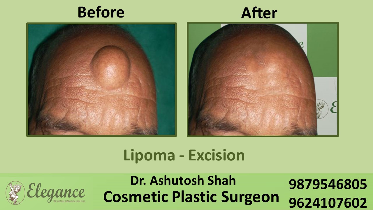 Liposuction Lipoma Removal Surgery Valsad, Gujarat, India.