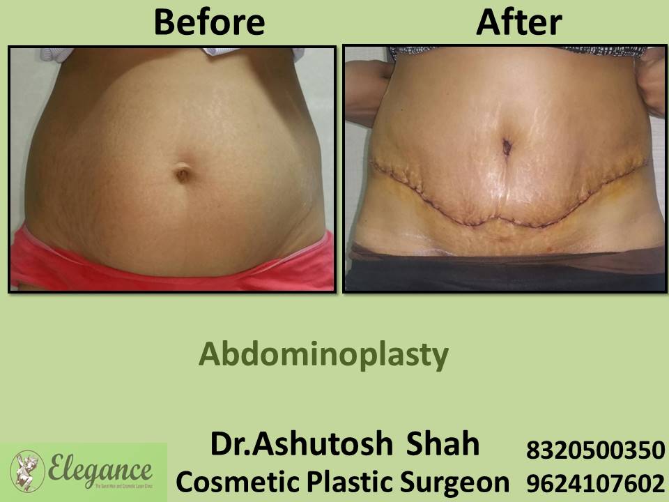 Recovery after abdominoplasty, fat removing surgery, plastic surgeon clinics, sarthana, palanpor, pal, jahangirpura, surat, gujarat.