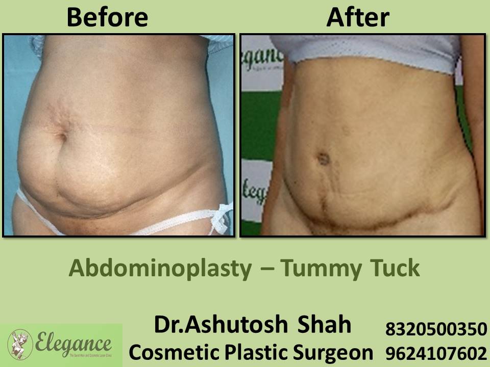Abdominoplasty liposuction, loose muscles and fats, rander, gopipura, nanpura, katargam, surat, gujarat.