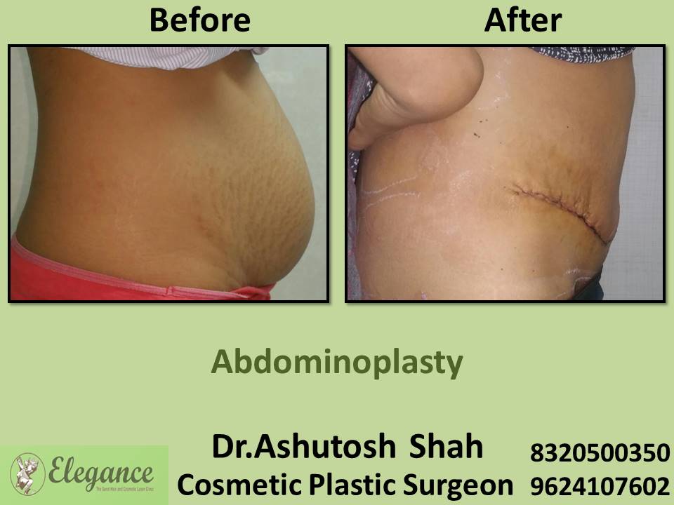 Recovery after abdominoplasty, fat removal, plastic surgeon clinics, bharuch, navsari, valsad, surat, south gujarat.