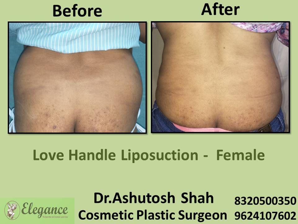 Love handle liposuction - female, fat removal surgery, nanpura, gopipura, athwa, ramder, surat, gujarat.