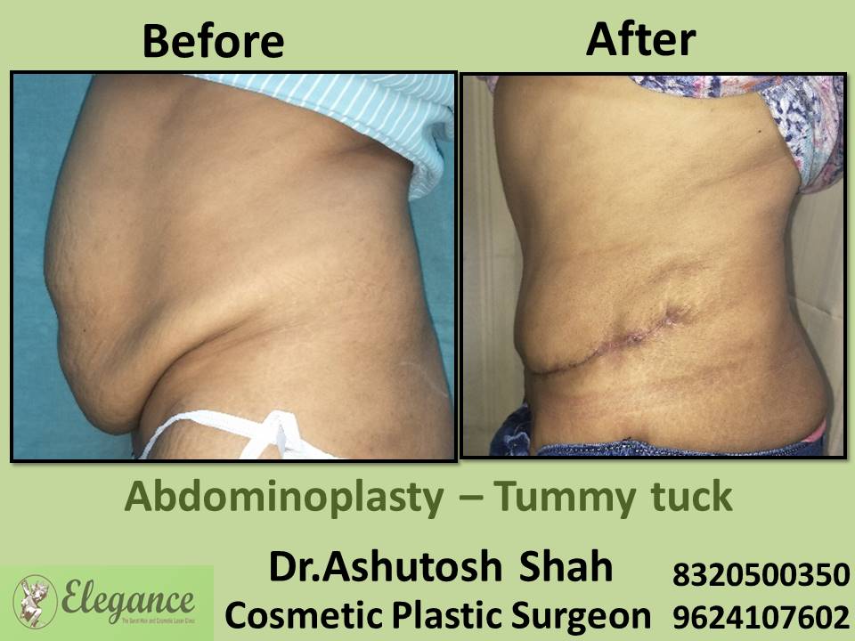 Abdominoplasty tummy tuck , surgey, repair, rander, adajan, athwa, umra, surat, gujarat.