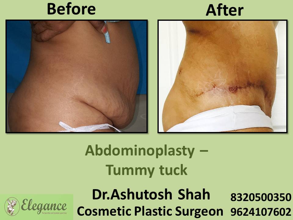 Abdominal tummy tuck, fat removal, surgery, rander, olpad, bhatar, pandesara, surat, gujarat.