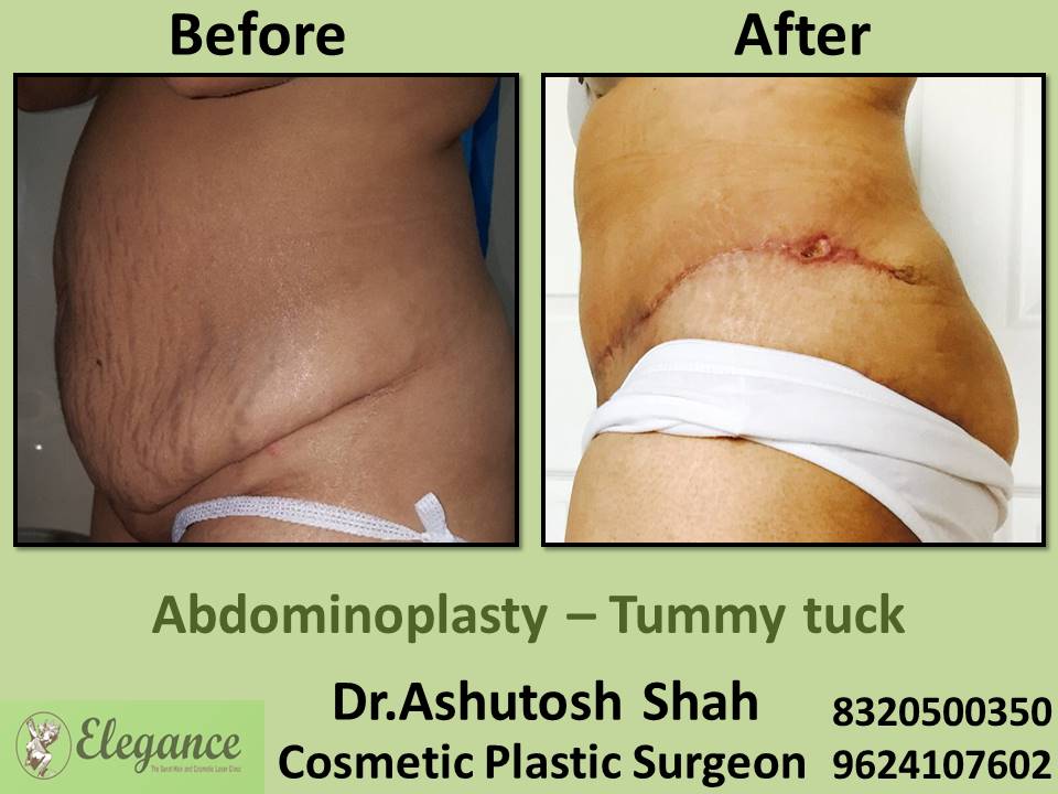 Tummy tuck procedure, removing fats by surgery, surat, bharuch , navsari, dang, gujarat.