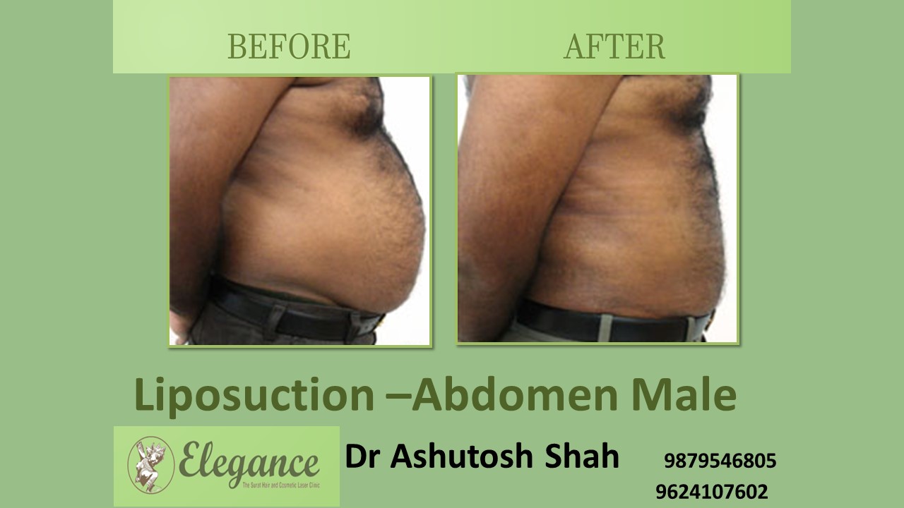 Abdoman Liposuction Male In Surat, Gujarat, India