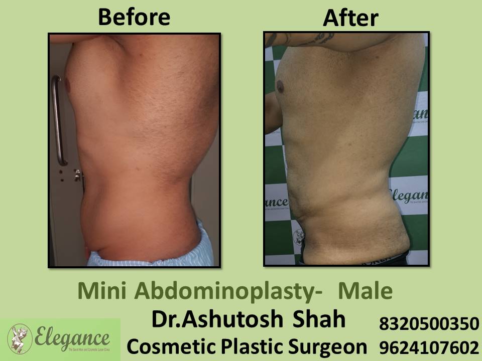 Mini abdominoplasty - male, liposuction surgery, cosmetic surgery, nanpura, gopipura, bharuch, surat, gujarat.