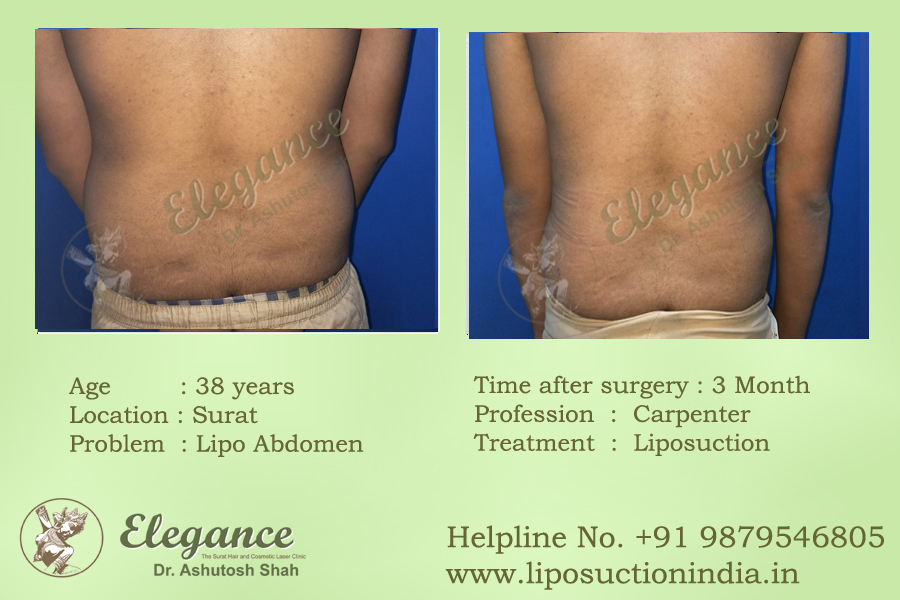 Liposuction Before and After Surat, Gujarat, india