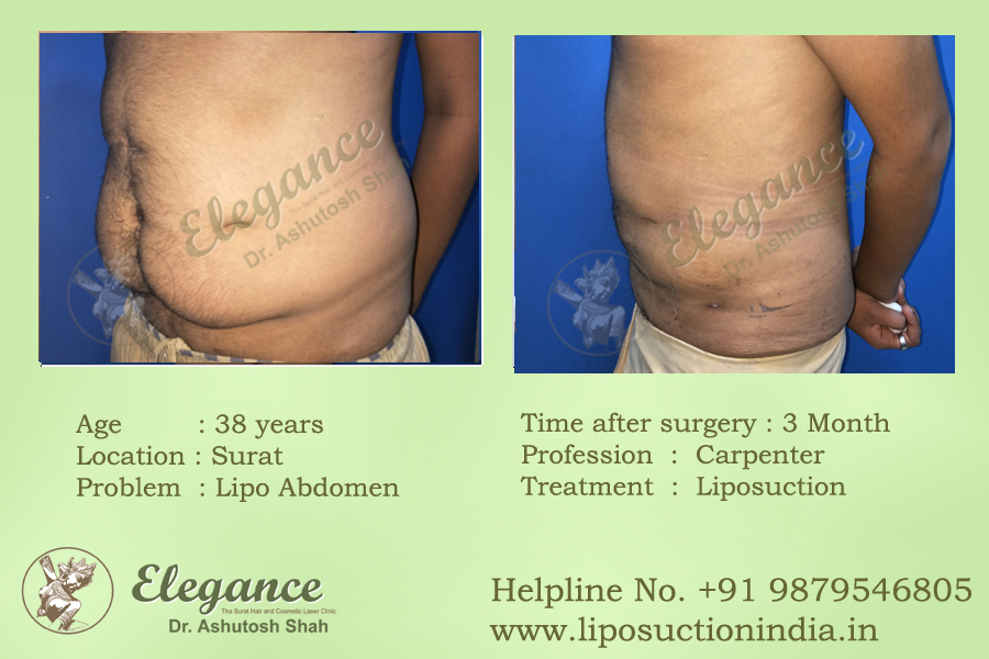 Liposuction Cost Surat, Gujarat, india