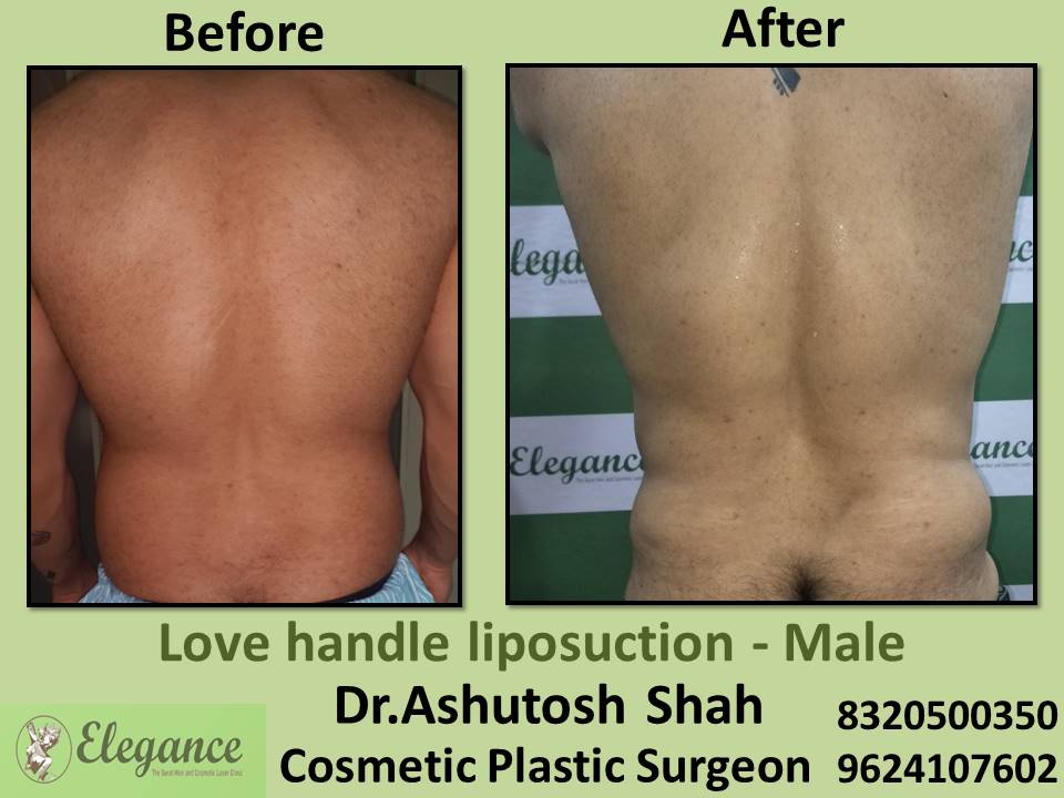 Love handle liposuction - male, fat removal surgery, nanpura, gopipura, athwa, ramder, surat, gujarat.