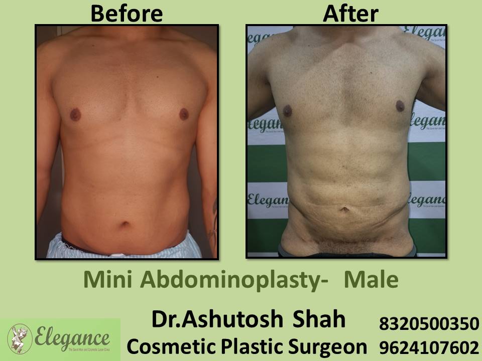 Mini abdominoplasty - male, affordable surgery, tummy tuck removing, nanpura, gopipura, bharuch, surat, gujarat.
