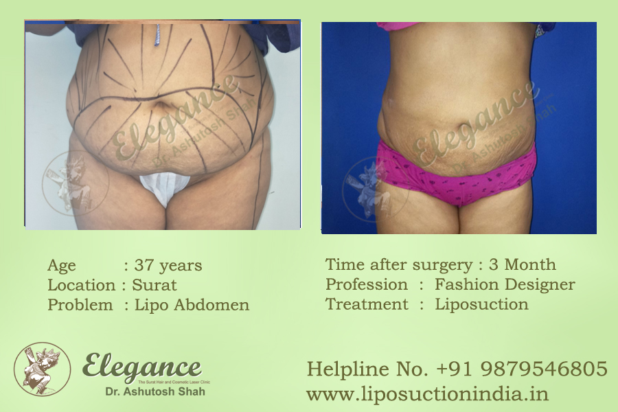 Liposuction Procedure Surat, Gujarat, india