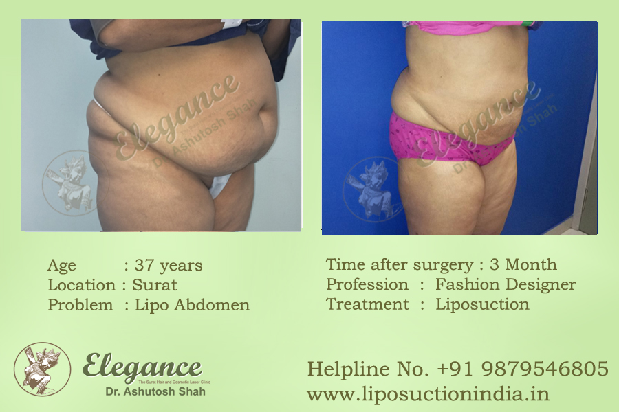 Liposuction Results Surat, Gujarat, india