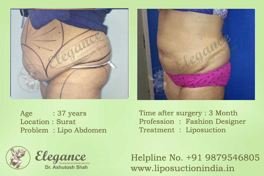 Liposuction Transplant Results Surat, Gujarat, india