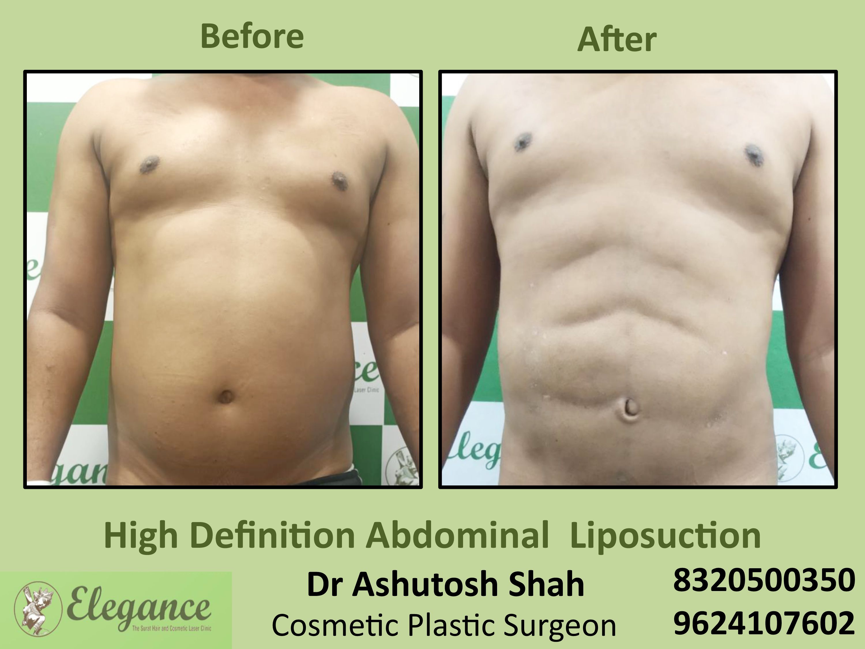 Liposuction Surgery, Fat Reduction in Piplod, Surat