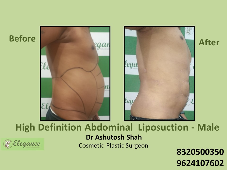 High Definition Abdominal Liposuction in Vesu, Piplod, Surat
