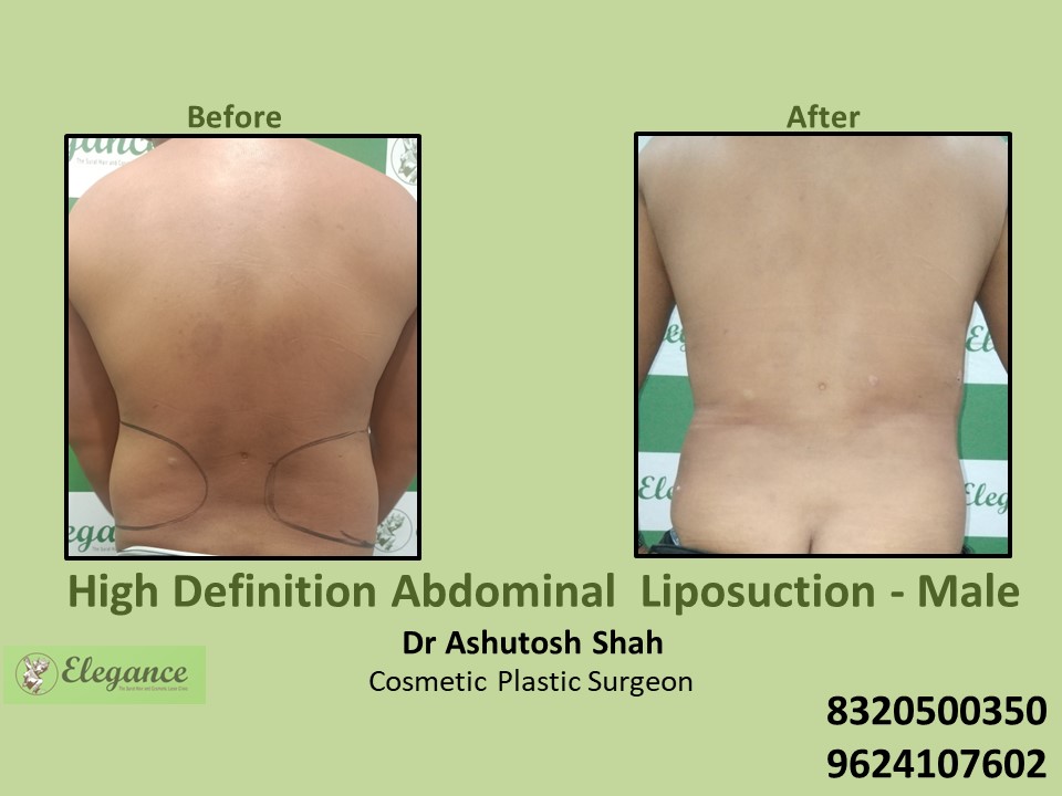 High Definition Abdominal Liposuction in Vesu, Athwagate, Surat