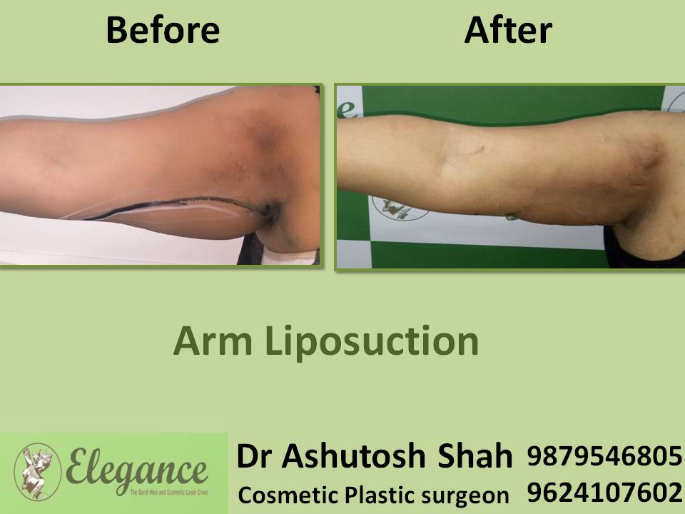 Arm liposuction in Nagpur, Maharashtra, India