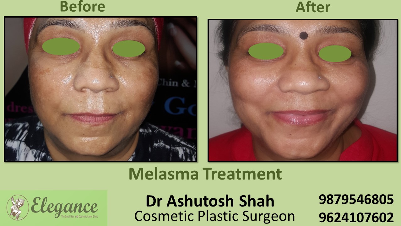 Best Skin Treatment, Melasma Treatment In Surat, Bharuch, Vapi, Gujarat .