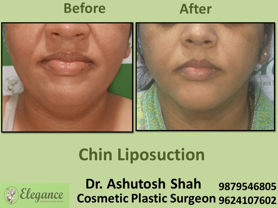 Chin Liposuction in Anand, Surat