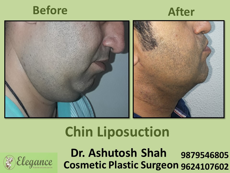 Chin Liposuction in Bharuch, Surat