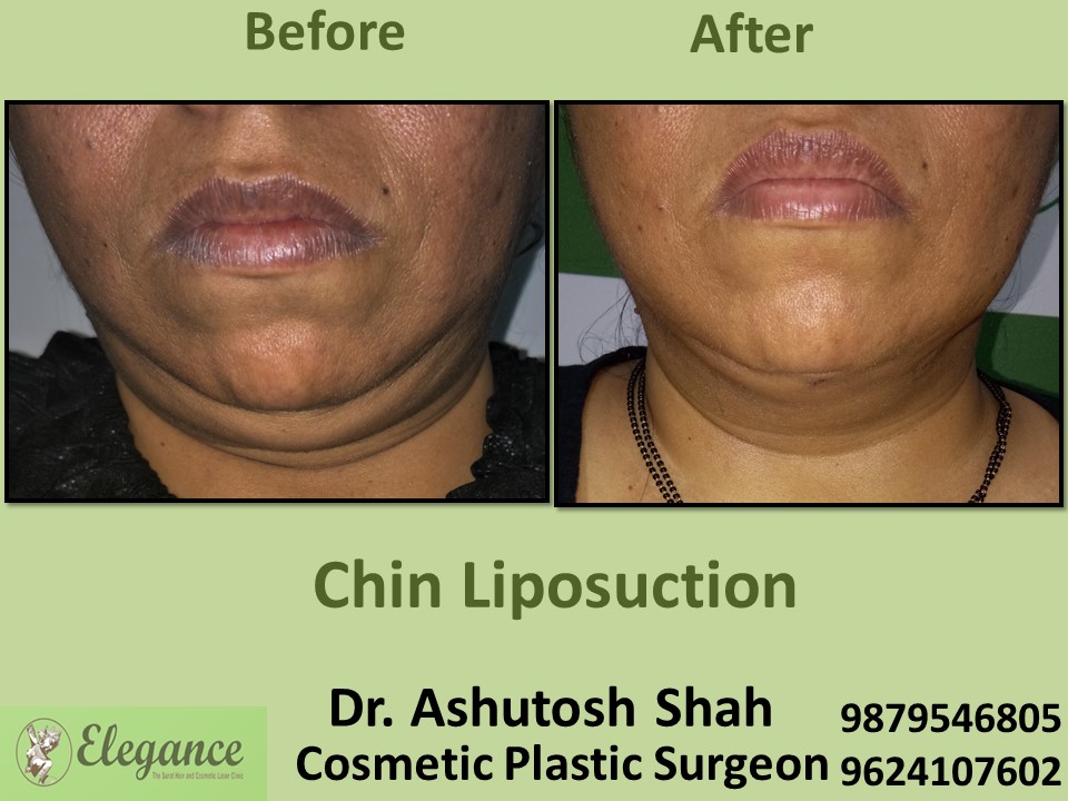 Chin Liposuction in Bilimora, Surat
