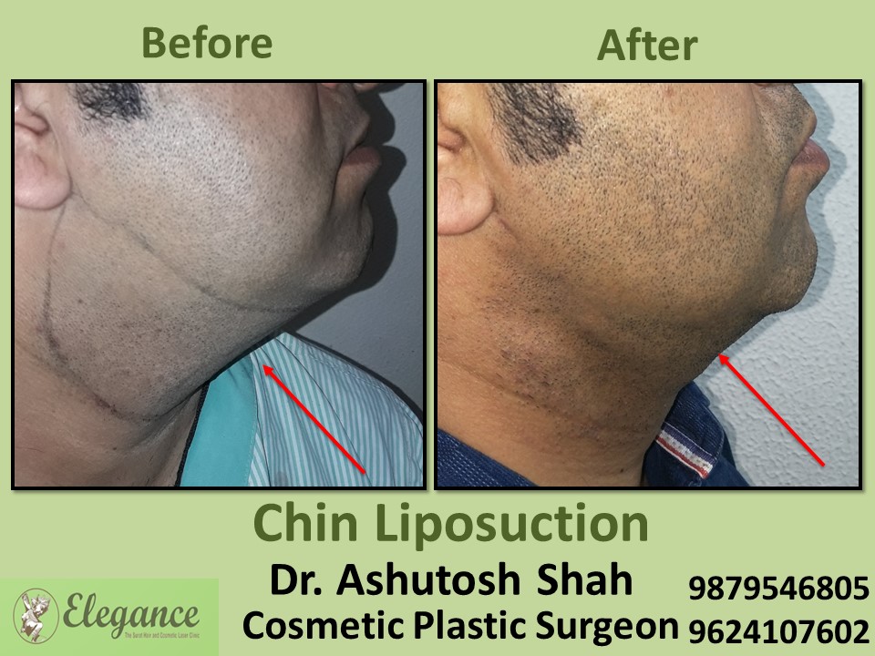 Chin Liposuction in Kim, Surat