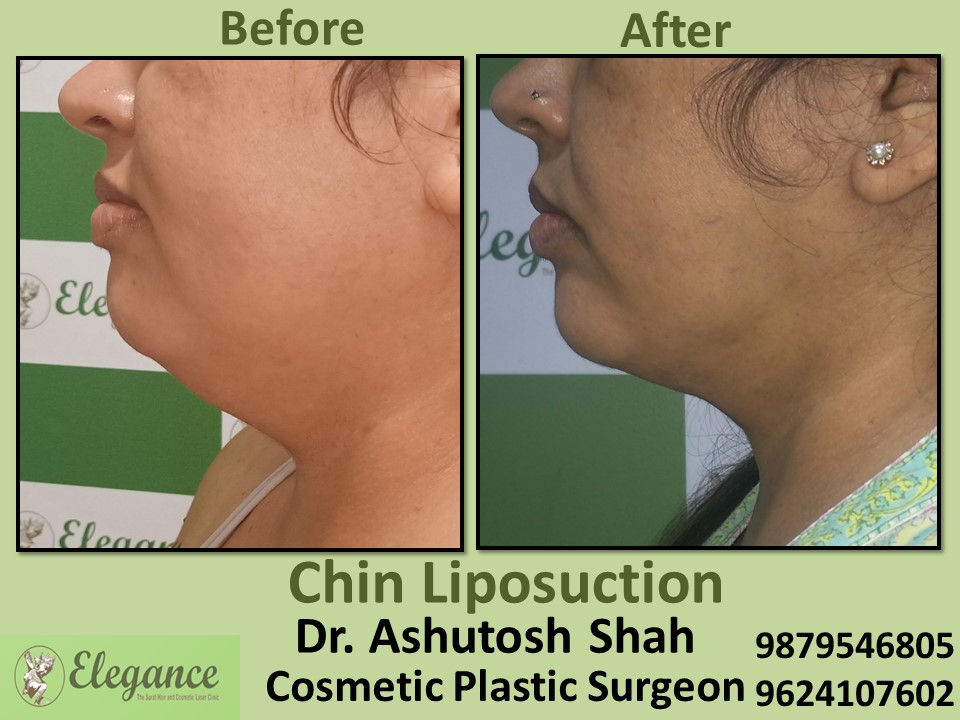 Chin Liposuction in Navsari