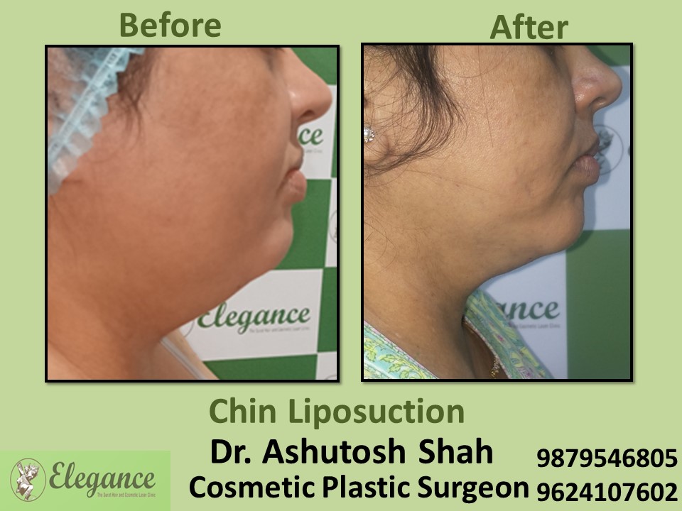 Chin Liposuction in Surat