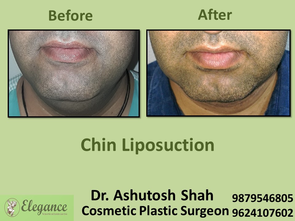 Chin Liposuction in Valsad, Surat