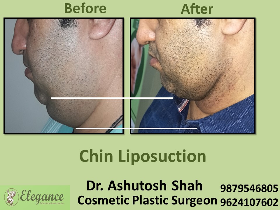 Chin Liposuction in Vapi, Surat