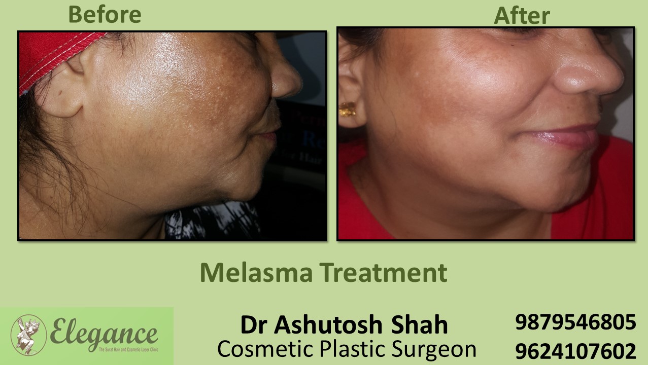 Facial Treatment, Clear Skin Treatment, Melasma Treatment In Surat, Valsad, Vapi, Gujarat.