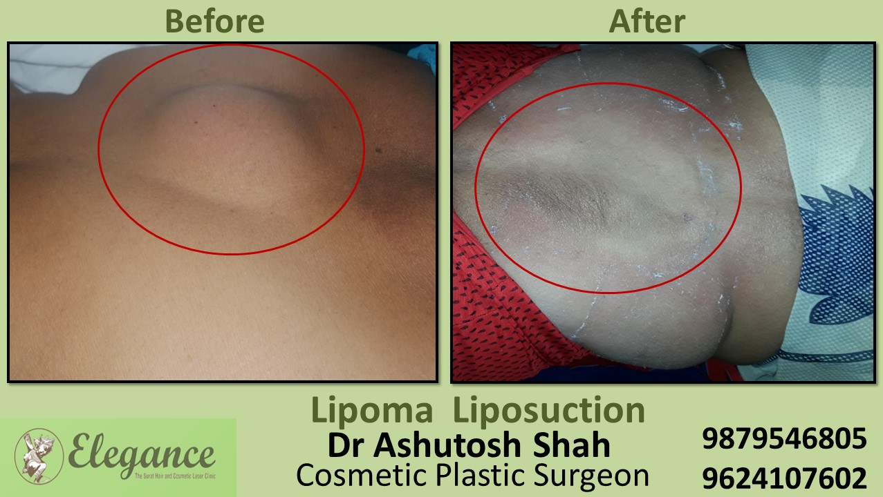 Lipoma Removal Treatment, Lumps Removal Surgery In Surat, Vapi, Bharuch, Gujarat.