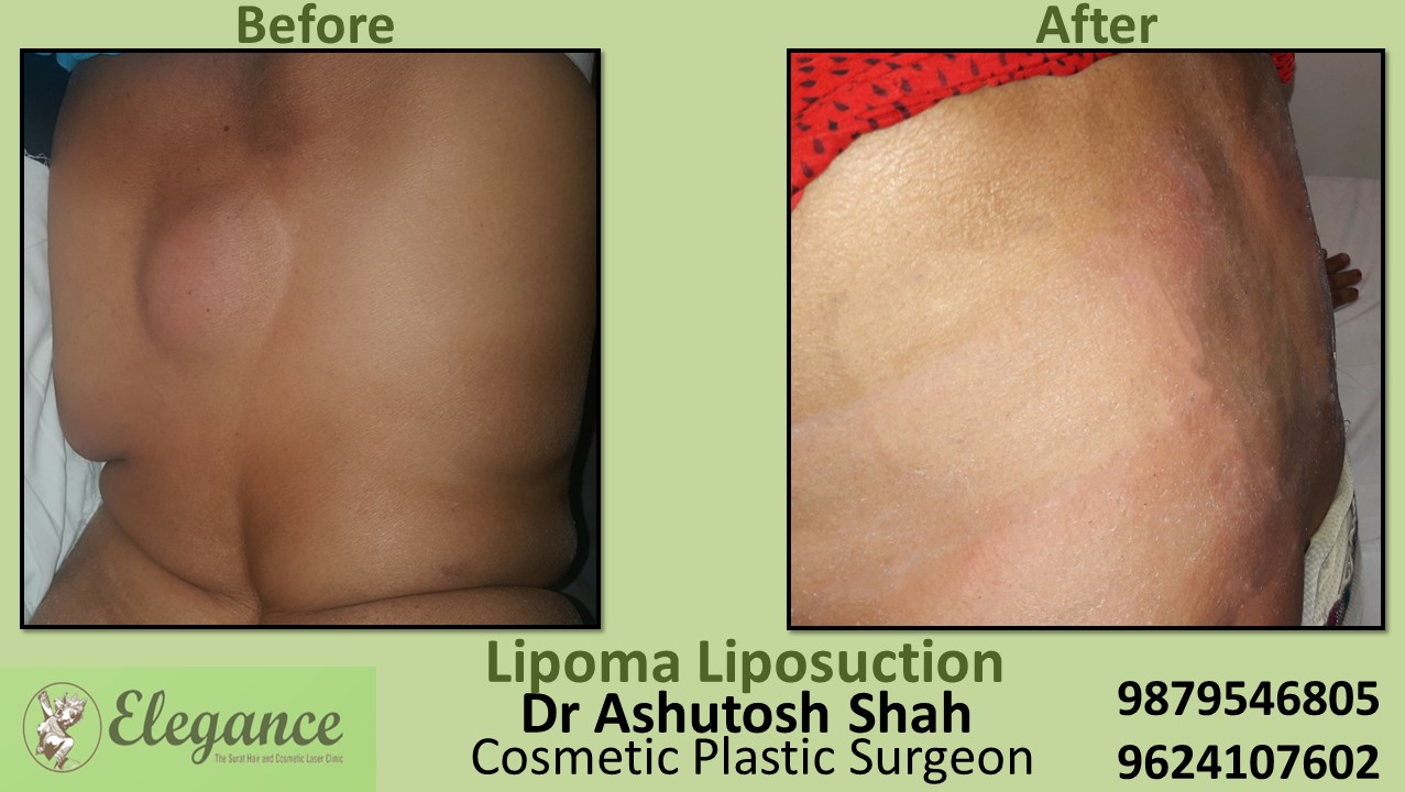 Lipoma Surgery, Liposuction surgery In Surat, Vapi, Bharuch ,Gujarat.