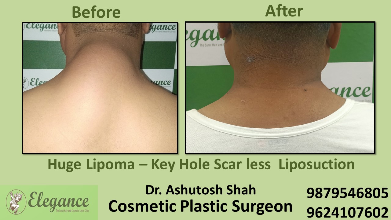 Best Clinic for Lipoma Removal Treatment in Piplod, Surat