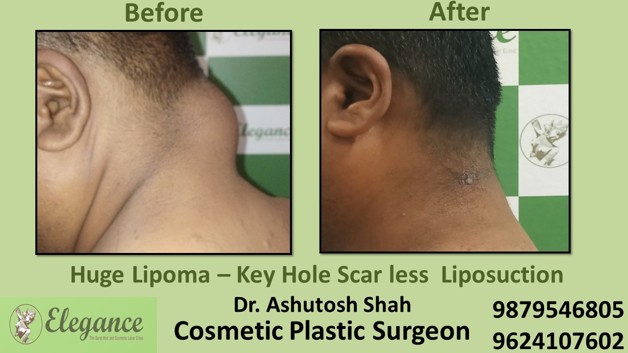 Lipoma, Liposuction Treatment in Surat, Gujarat