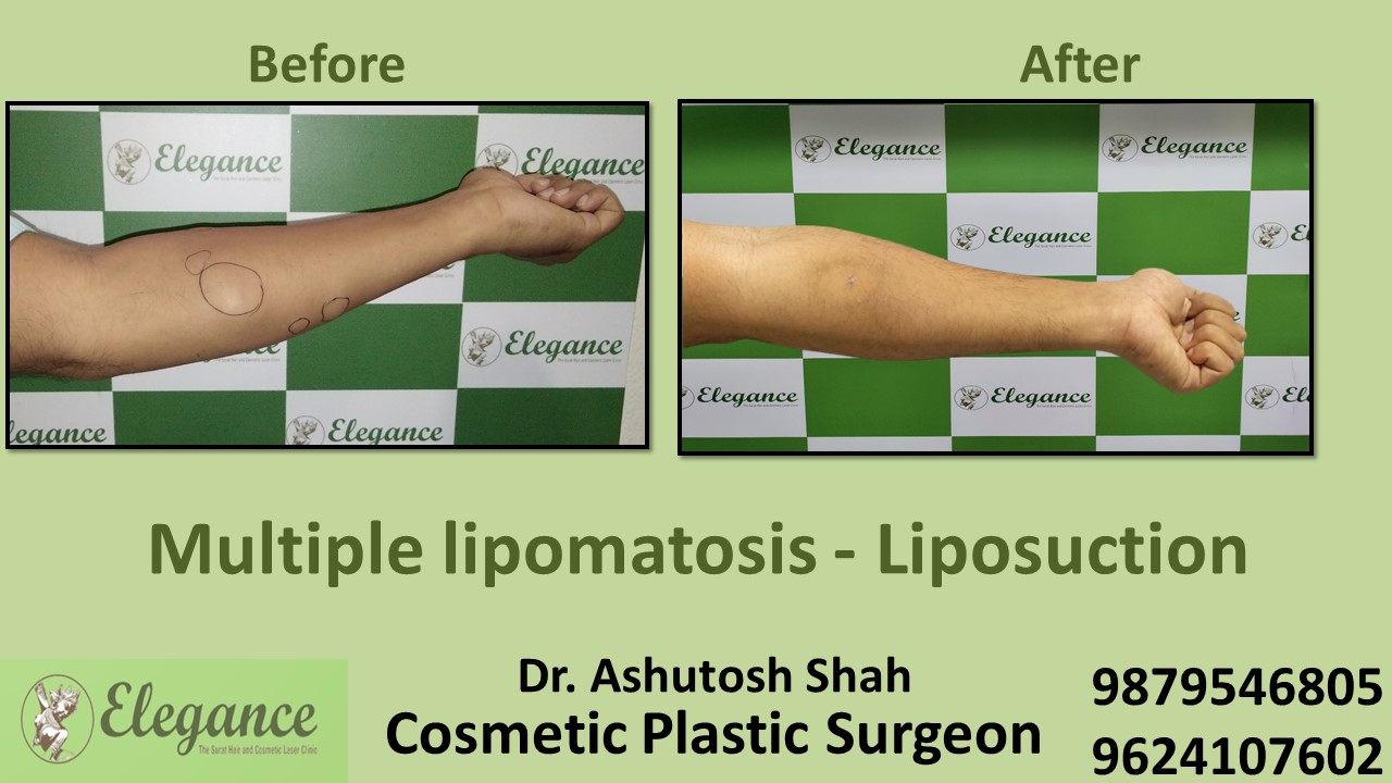 Lipoma Reduction Surgery in Surat, Gujarat