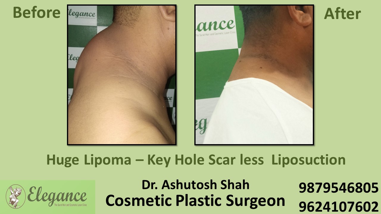 Lipoma Surgery at low cost in Adajan, Surat, Gujarat