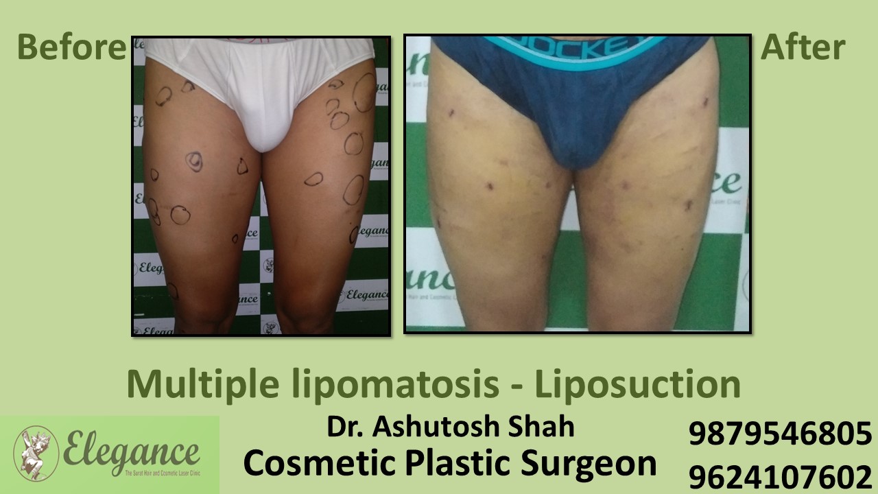 Lipoma Surgery in Vapi, Surat, Gujarat
