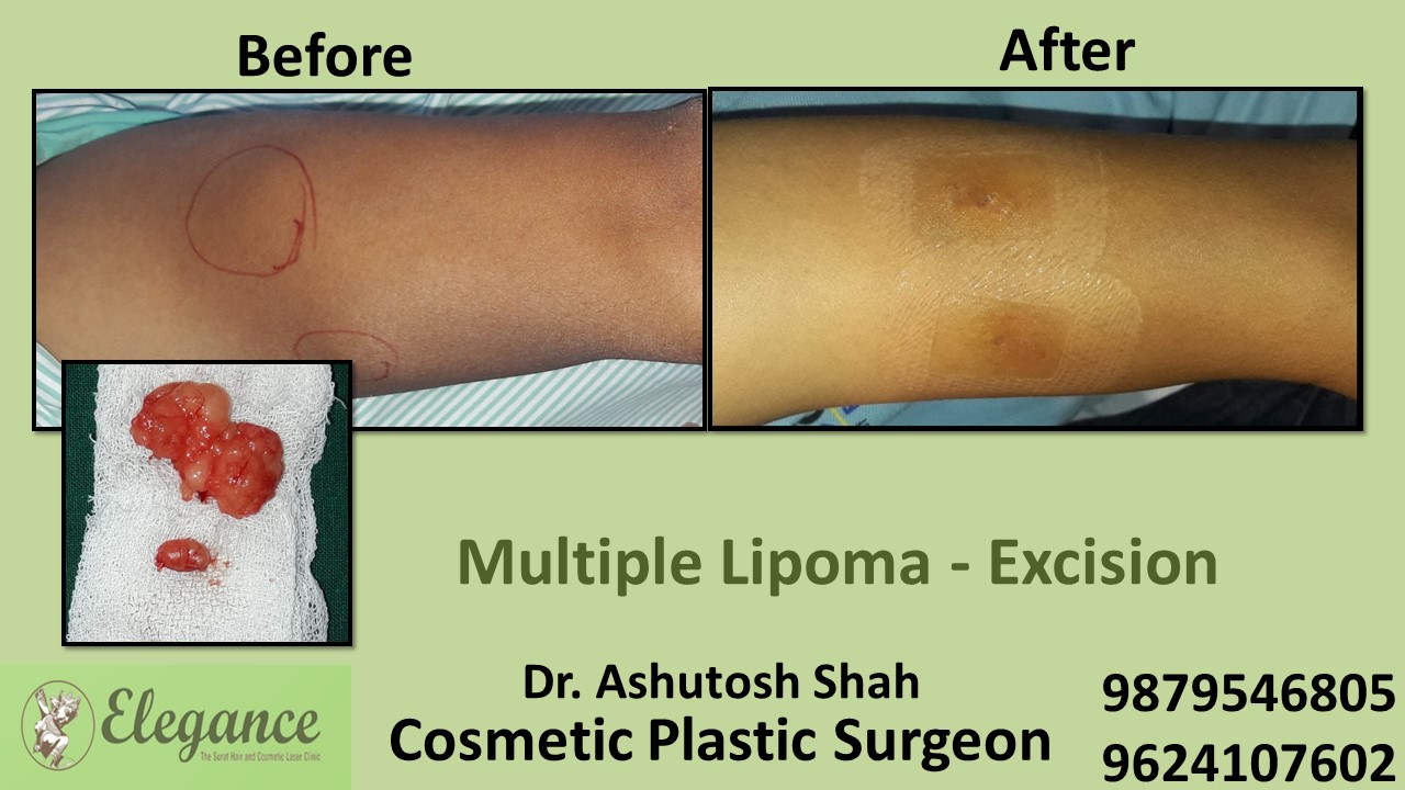 Lipoma Treatment in Ankleshwar, Surat