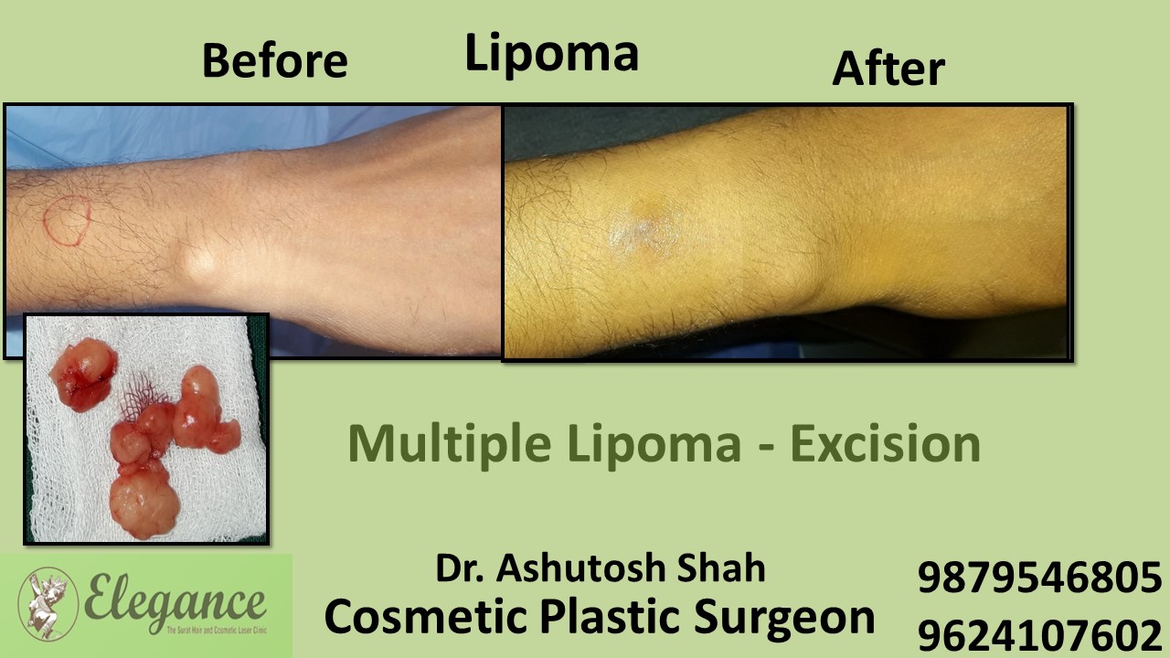 Lipoma Treatment in Bharuch, Surat