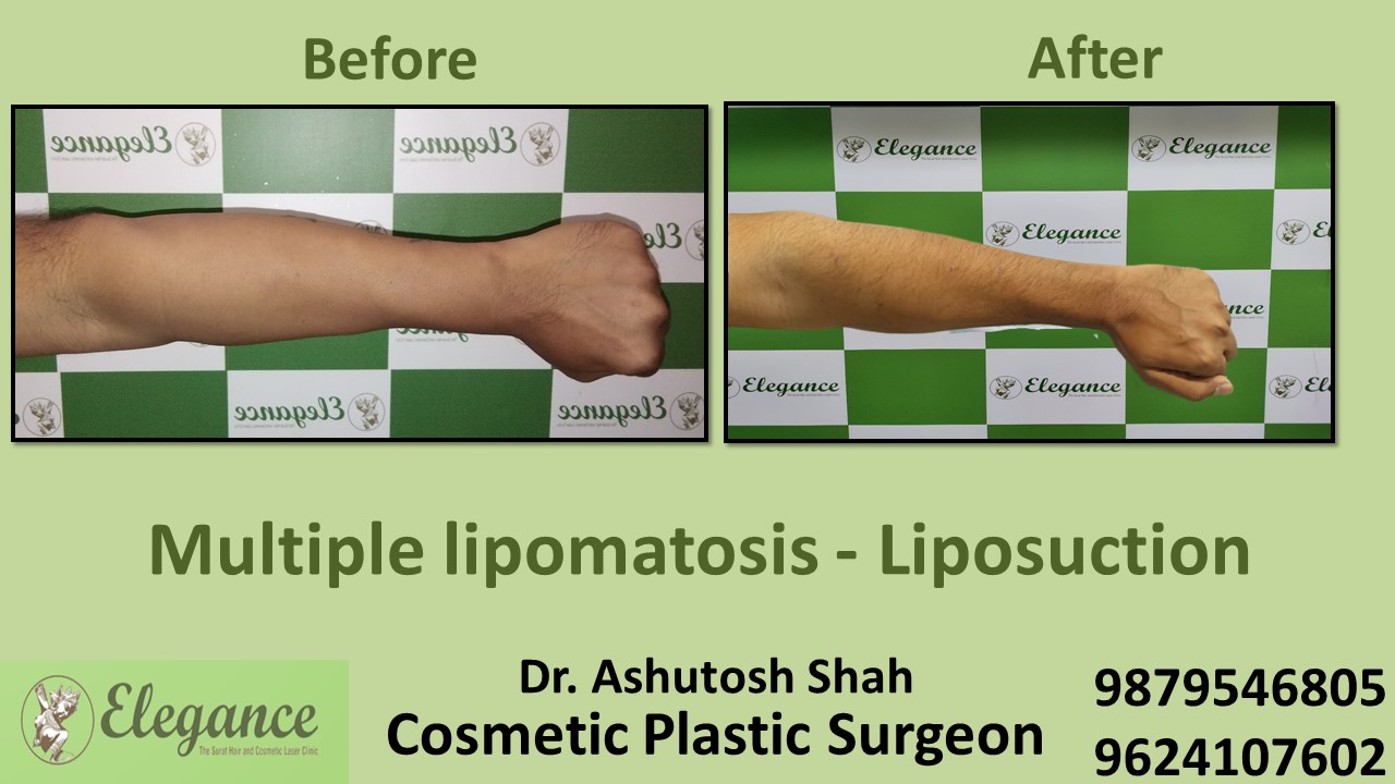 Liposuction of multiple Lipoma Treatment in Bharuch, Surat, Gujarat