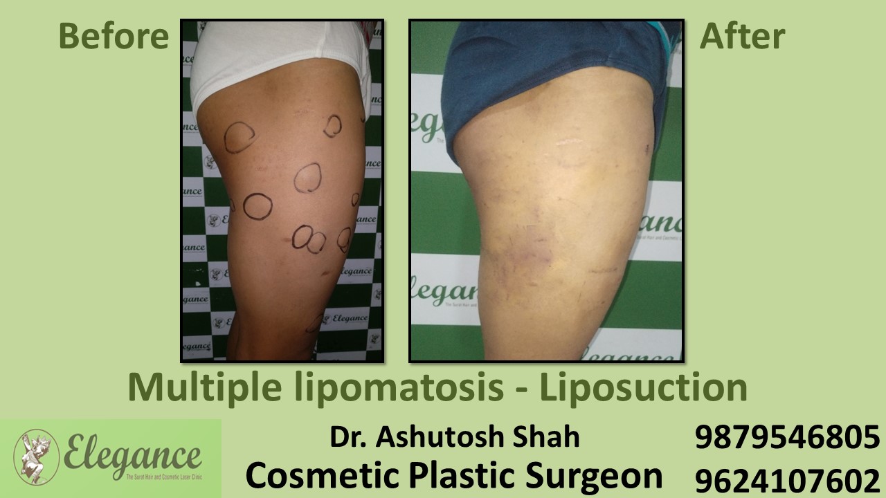 Liposuction Surgery at low Cost in Surat , Gujarat