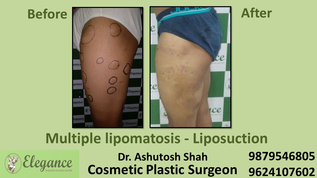 Liposuction Treatment for Multiple Lipoma in Surat, Gujarat