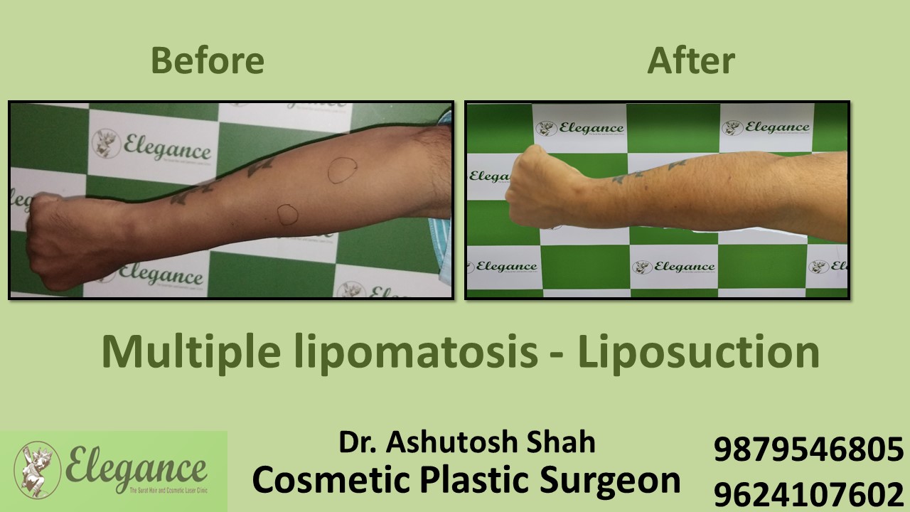 Low Cost Treatment of Lipoma in Valsad, Surat, Gujarat