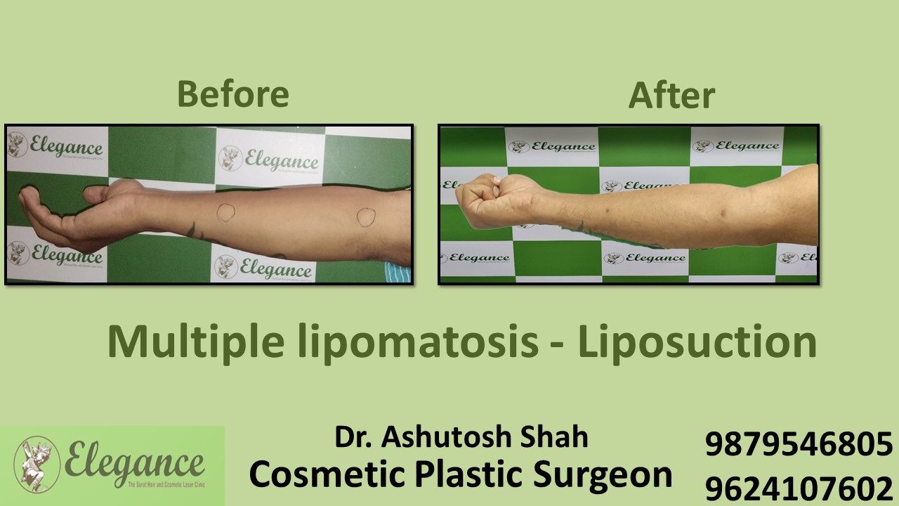 Treatment for Multiple Lipoma in Navsari, Surat, Gujarat