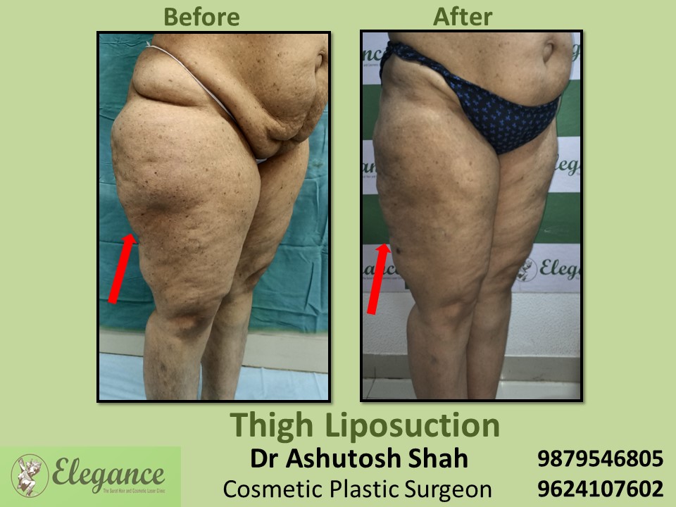 Liposuction-Affordable Thigh Fat Treatment In Surat, Vapi, Bharuch.