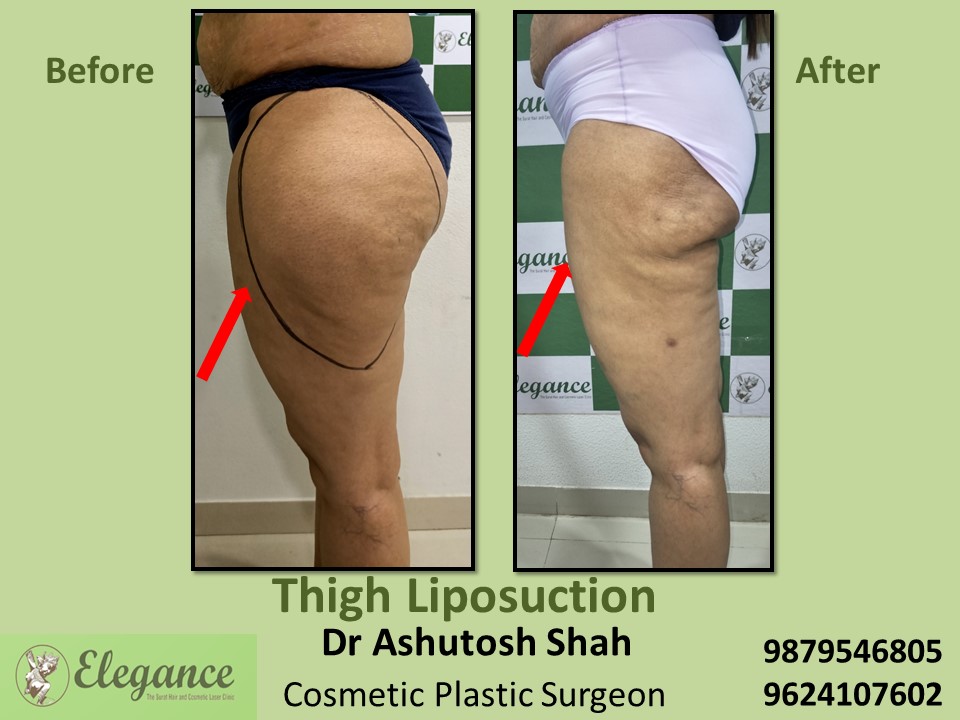 Liposuction-Best Hospital For Thigh Fat Reduction In Surat, Nandurbar, Nasik.