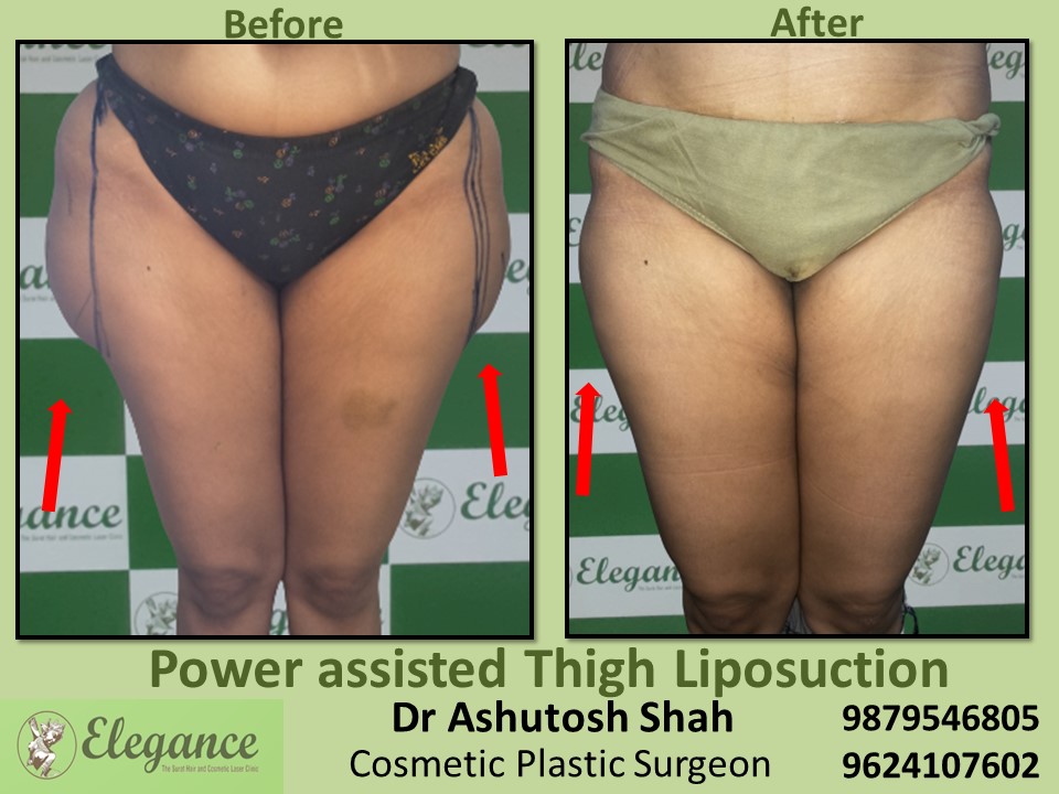 Liposuction-Best Thigh Fat Removal Doctor In Surat, Navsari, Vapi.