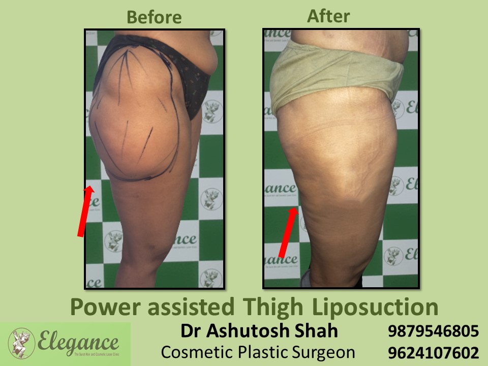 Liposuction  Best Thigh Removal Hospital In Surat, Ankleshwar, Vapi.